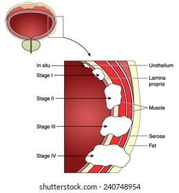 Stages of bladder cancer from in-situ to stage IV. Created in Adobe Illustrator.  Contains transparencies and gradients.  EPS 10.