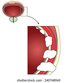 Stages of bladder cancer from in-situ to stage IV. Created in Adobe Illustrator.  Contains transparencies and gradients.  EPS 10.