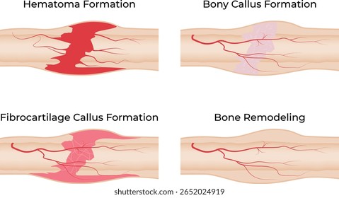 Etapas de la curación de la fractura ósea Hematoma Callo Formación y remodelación