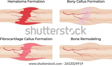 Stages of Bone Fracture Healing Hematoma Callus Formation and Remodeling