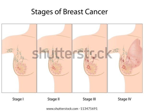 Descubra Etapas Del Cancer De Mama Imagenes De Stock En Hd Y Millones De Otras Fotos Ilustraciones Y Vectores En Stock Libres De Regalias En La Coleccion De Shutterstock Se Agregan Miles De Imagenes Nuevas De Alta Calidad Todos Los Dias