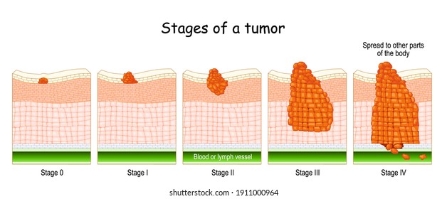 Stages Of Cancer. Classification Of Malignant Tumours (from 0 To 4). System That Is Most Commonly Used For The Staging Process Of Cancer 