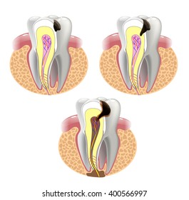 THE STAGES OF CARIES DEVELOPMENT