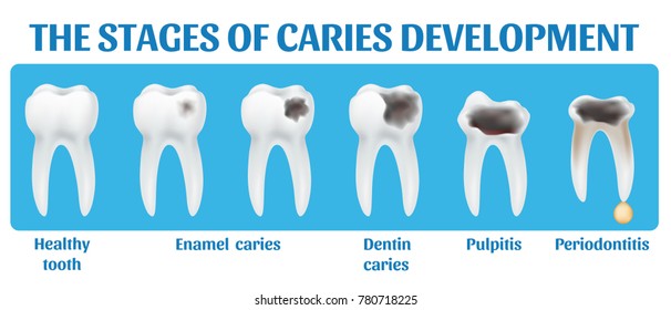 The stages of caries development. 3d realistic vector illustration. Enamel and dentin decay, banner for dentist office.