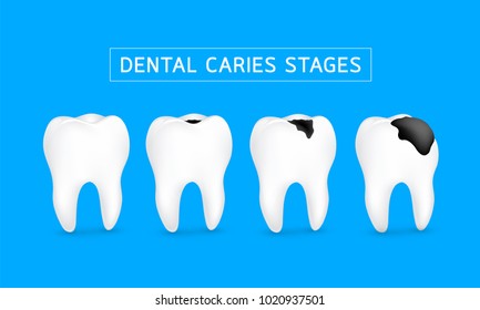 Stages of caries development. Dental care concept, illustration isolated on blue background.