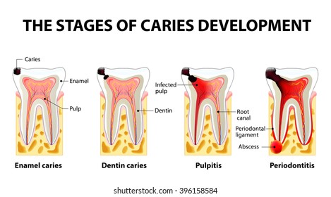 stages of caries development. Dental disease: caries, pulpitis and periodontitis