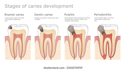 Stages of caries development dental illustration. Illustration showing the development of caries in a human tooth. The tooth is progressively destroyed as the caries grows.