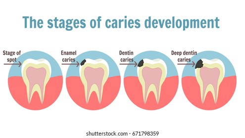 The stages of caries development. Dental toothache symbol. Illustration of tooth with spot, enamel caries, dentin caries and deep dentine caries