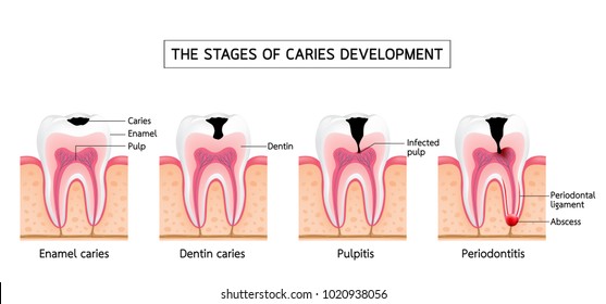 Stages Caries Development Enamel Caries Dentin Stock Vector (Royalty ...