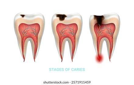 Stages of caries development in human molar. Vector isolated unhealthy tooth with dark, decayed area on occlusal surface with visible pits and holes. Dental diseases, cavities and periodontitis