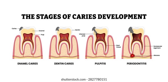 Stages of caries development stages. Labeled enamel, dentin caries, pulpitis, periodontitis. Infected pulp. Tooth structure anatomy with abscess, root canal. Periodontal ligament. Medical illustration