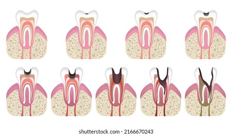 Stages of caries development. Tooth structure in flat style. Tooth decay with enamel. Dental disease caries, pulpitis and periodontitis, realistic vector illustration