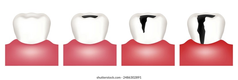 Stages of caries development. Vector illustration.