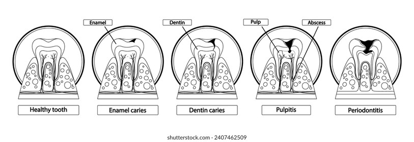 Stages Of Caries Infographic. Healthy Tooth, Enamel Caries, Dentin Caries, Pulpitis and Periodontitis Cross Section View