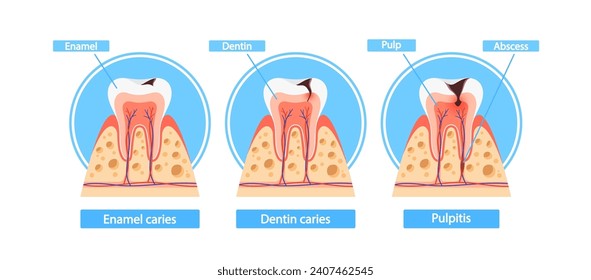 Stages Of Caries Infographics. Enamel Caries, Dentin Caries, And Pulpitis Cross Section View. Medical Visual Information