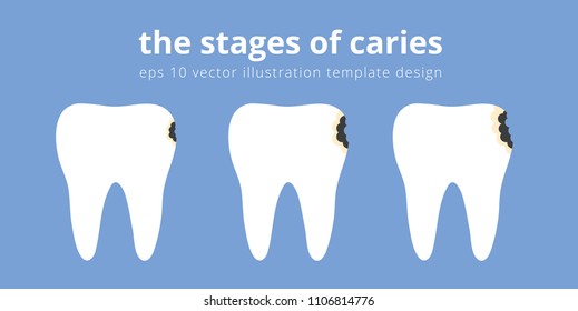 Stages of caries tooth vector illustration, flat cartoon eps 10 design