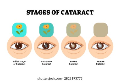 Stages of cataract stage process development. Eye disease infographic poster. Labeled initial, immature, brown and mature cataract with eye and Vision loss problem. Healthcare illustration vector.