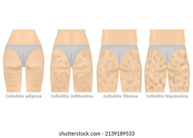 stages of cellulite. Women's hips and stages of obesity. Overweight . Vector illustration