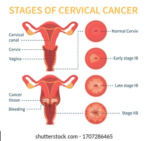 Stages of cervical cancer. Women's reproductive system. The effect of papillomavirus on the cervix. Vector infographic.