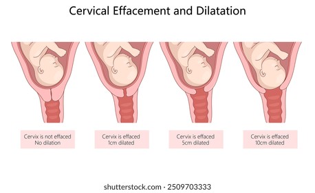 etapas de borramiento cervical y dilatación durante el trabajo de parto, que representan la apertura gradual y el adelgazamiento del diagrama del cuello uterino Ilustración vectorial esquemática dibujada a mano. Ilustración educativa de ciencia médica