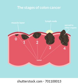 The Stages Of Colon Cancer. Vector Medical Illustration.