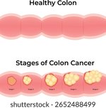 Stages of Colon Cancer A Visual Guide to Cancer Progression