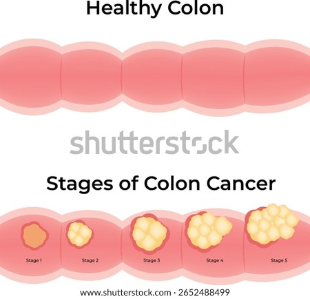 Stages of Colon Cancer A Visual Guide to Cancer Progression