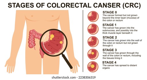 Stages of colorectal cancer CRC. Colon cancer. Colorectal oncology tumor.  Bowel cancer.