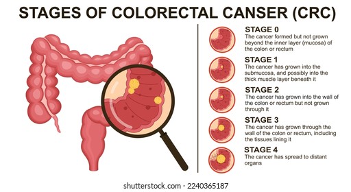 Stages of colorectal cancer CRC. Colon cancer. Colorectal oncology tumor. Bowel cancer.	
