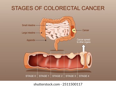 Estágios do câncer colorretal. Seção transversal do intestino grosso com tumor. Close de um tumor maligno do cólon. Cartaz detalhado do vetor. Ilustração plana isométrica. Diagrama esquemático