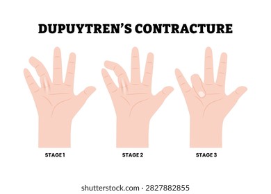 Stages of Dupuytren’s Contracture Hand Disease Stage Medical Illustration. Showing finger flexion deformity caused by thickened palmar tissue. Dermatology. Fibroproliferative disorder. Flat vector