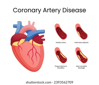 Etapas de la enfermedad arterial coronaria