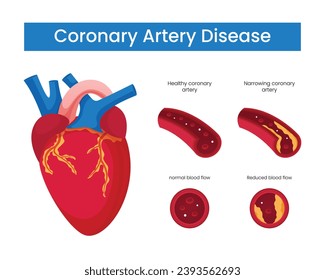 Etapas de la enfermedad arterial coronaria Ilustración