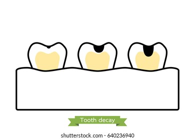 stages of decay tooth - dental cartoon vector outline style, cute character for design