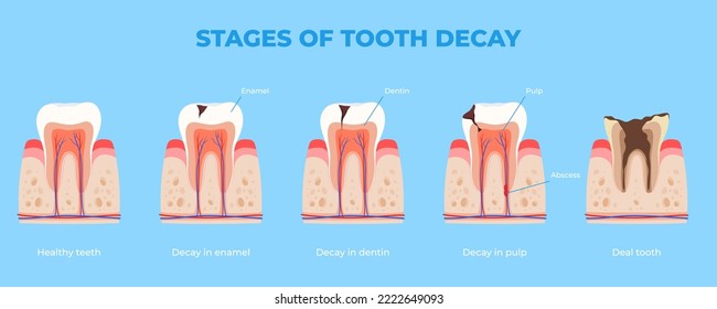 Stages of dental disease. Treatment of the oral cavity. Toothache. Vector illustration