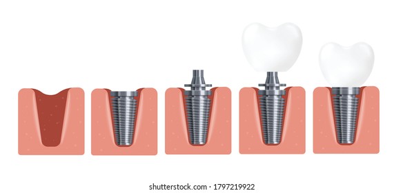 Stages of dental implant installation. Steps for placement of the dental implant in the gum. 3d realistic vector illustration of treatment teeth isolated on a white background.