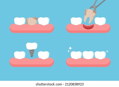 Stages of dental treatment. Tooth is removed by forceps. Teeth row with dental implant. Vector illustration isolated on blue background.
