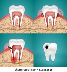 Stages of destruction. Steps of tooth decay. Realistic detailed cross-sectional view. Vector illustration.