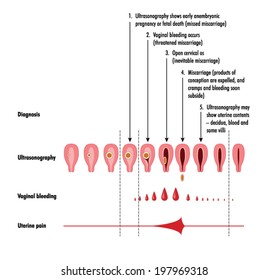 Stages and detection of miscarriage -- labelled