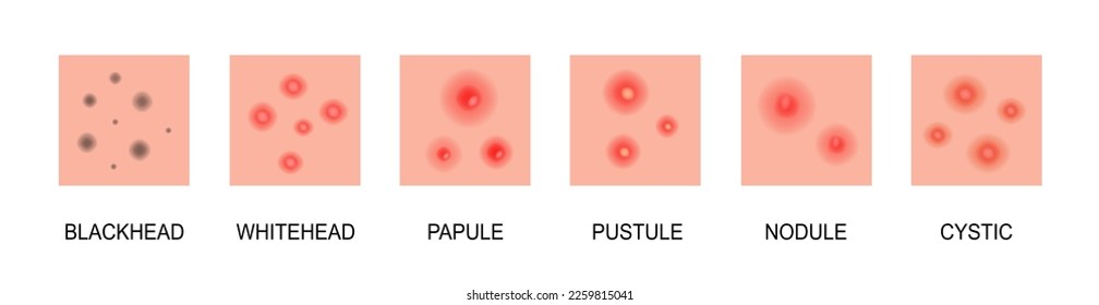 Stages of development of acne. Inflamed skin with scars, acne and pimples. Blackheads, whiteheads, papules, pustules, cystic and nodular