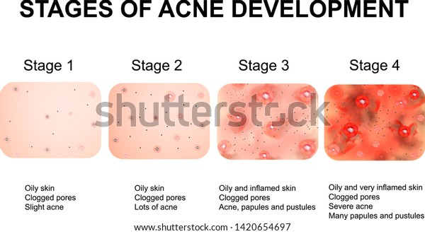 Estágios De Desenvolvimento Da Acne Pele Vetor Stock Livre De