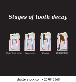 Stages of development of dental caries. Vector illustration on a black background.