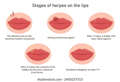 Stadien der Entwicklung von Herpes auf den Lippen. Entzündung im Gesicht. Orale Infektionskrankheit medizinische Behandlung. Hautpflege. Infografiken zur Vektorgrafik