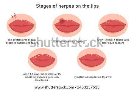 Stages of development of herpes on the lips. Inflammation skin face. Oral infection disease medical treatment. Skincare. Vector infographics