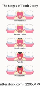 761 Stages Caries Images, Stock Photos & Vectors | Shutterstock