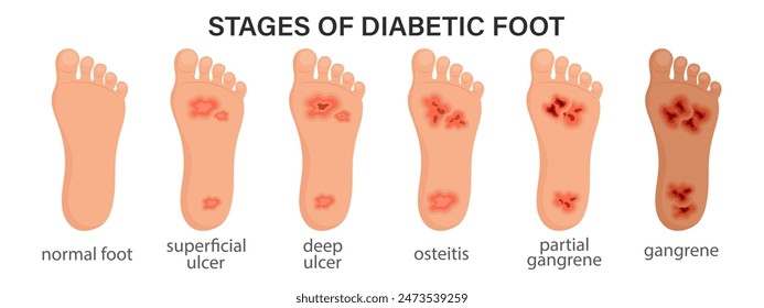 Estadios del síndrome del pie diabético. Úlcera profunda, herida abierta en el pie. Pie diabético o diabetes, gangrena, necrosis, neuropatía, fascitis necrotizante. Anuncio de infografías médicas