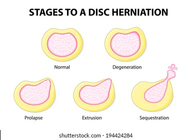 stages to a disc herniation. Normal, Degeneration, Prolapse, Extrusion, Sequestration