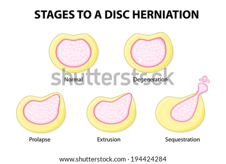 stages to a disc herniation. Normal, Degeneration, Prolapse, Extrusion, Sequestration