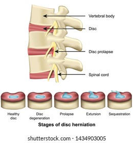 Stages Of Disc Herniation Spine And Disc Anatomy 3d Medical Vector Illustration Eps 10