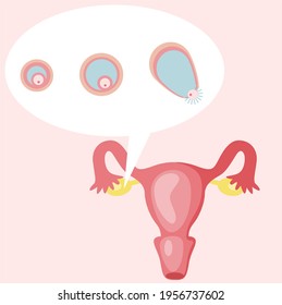 stages of egg development in the ovaries during ovulation in a healthy woman. ovulation of a woman planning a pregnancy. visual aid for gynecologists and mature women.